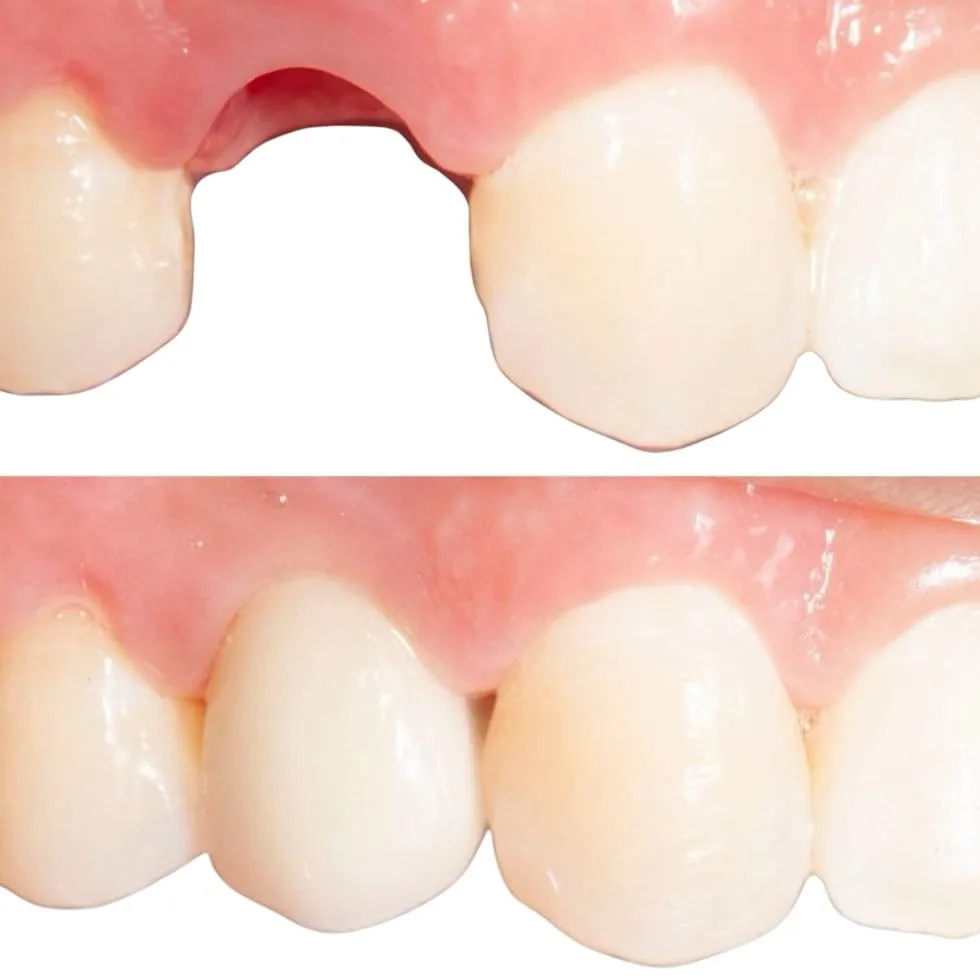 Antes e Depois Implantes Dentários