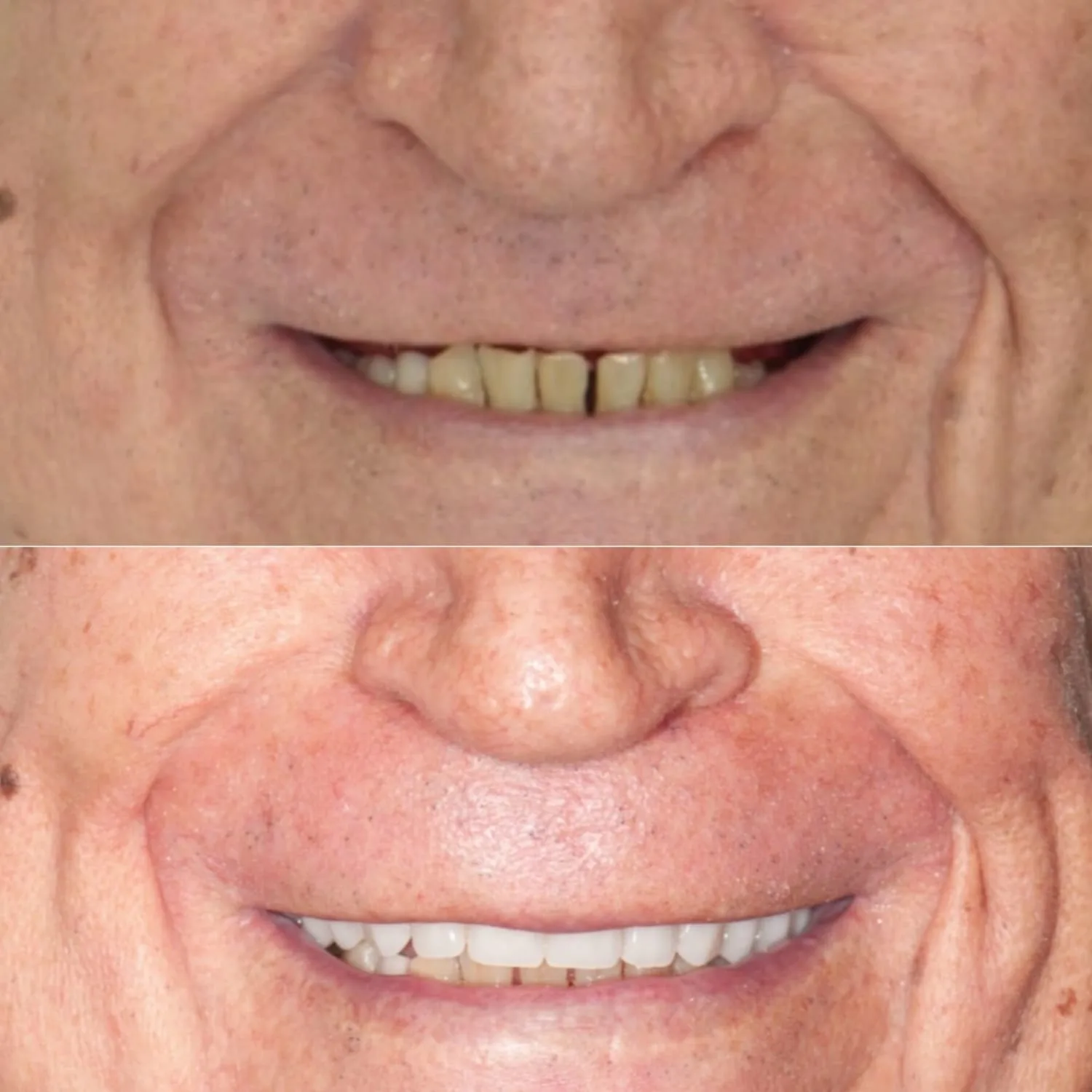 Transformação com Facetas de Porcelana