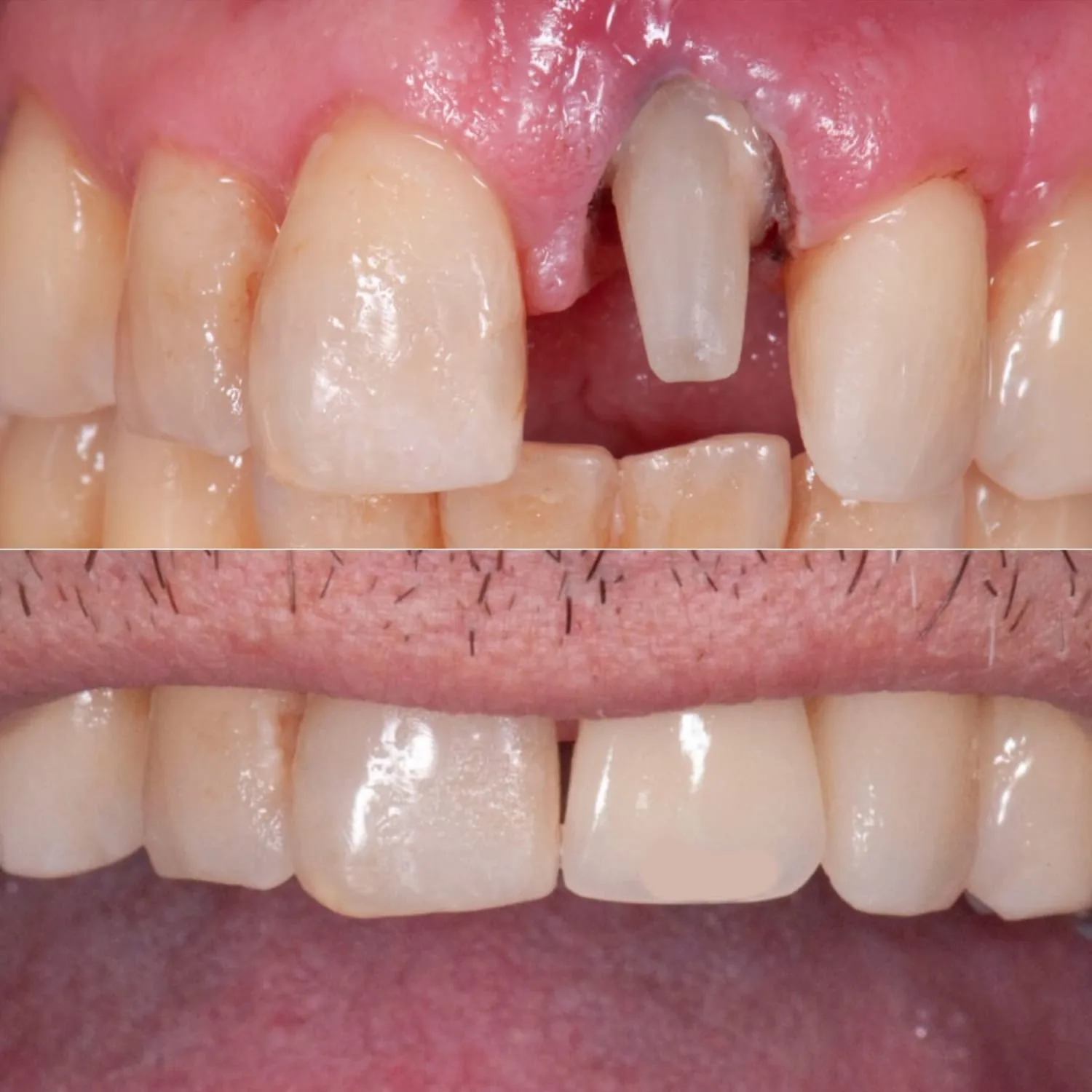 Resultado de Clareamento Dental